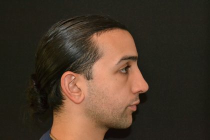 Rhinoplasty Before & After Patient #19620