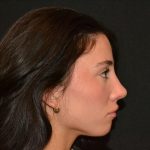 Rhinoplasty Before & After Patient #19622