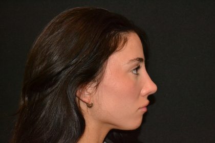 Rhinoplasty Before & After Patient #19622