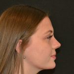 Rhinoplasty Before & After Patient #19619