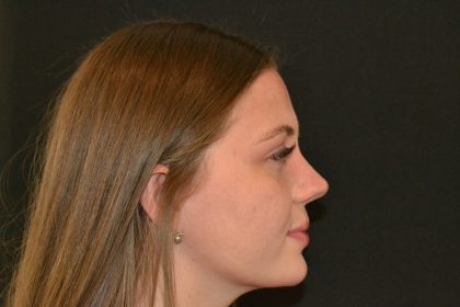 Rhinoplasty Before & After Patient #19619