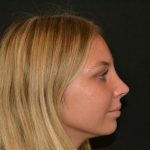 Rhinoplasty Before & After Patient #19623