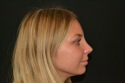 Rhinoplasty Before & After Patient #19623