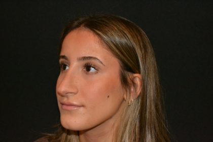 Rhinoplasty Before & After Patient #19621