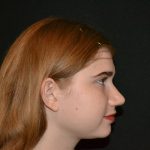 Rhinoplasty Before & After Patient #19625