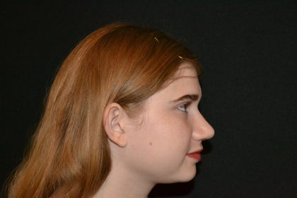 Rhinoplasty Before & After Patient #19625