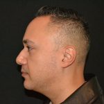 Chin Augmentation Before & After Patient #19626