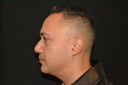 Chin Augmentation Before & After Patient #19626