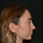 Rhinoplasty Before & After Patient #19627
