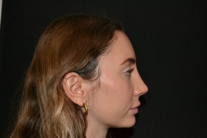 Rhinoplasty Before & After Patient #19627