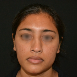 Revision Rhinoplasty Before & After Patient #19617
