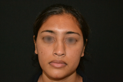 Revision Rhinoplasty Before & After Patient #19617