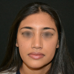 Revision Rhinoplasty Before & After Patient #19617
