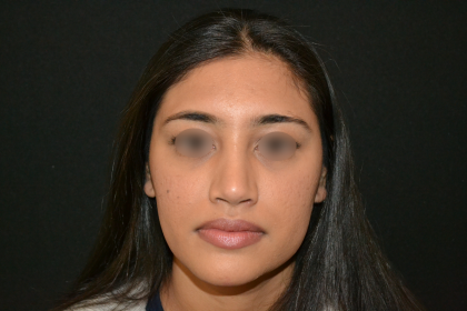 Revision Rhinoplasty Before & After Patient #19617