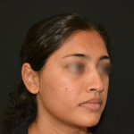 Revision Rhinoplasty Before & After Patient #19617