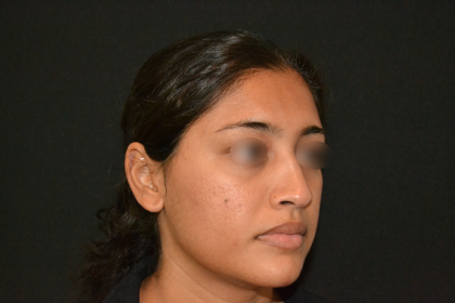 Revision Rhinoplasty Before & After Patient #19617