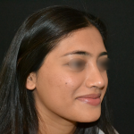 Revision Rhinoplasty Before & After Patient #19617