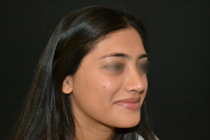 Revision Rhinoplasty Before & After Patient #19617