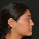 Revision Rhinoplasty Before & After Patient #19617
