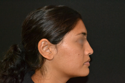 Revision Rhinoplasty Before & After Patient #19617