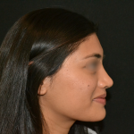 Revision Rhinoplasty Before & After Patient #19617