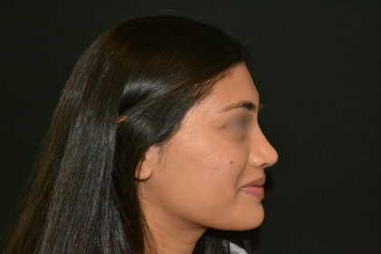 Revision Rhinoplasty Before & After Patient #19617