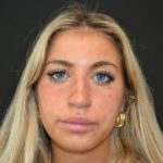 Rhinoplasty Before & After Patient #19763