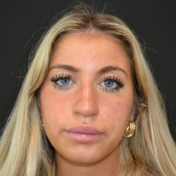 Rhinoplasty Before & After Patient #19763