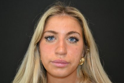 Rhinoplasty Before & After Patient #19763