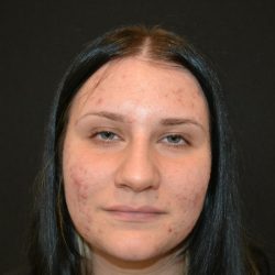 Rhinoplasty Before & After Patient #19712