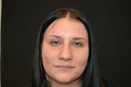 Rhinoplasty Before & After Patient #19712