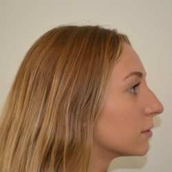 Rhinoplasty Before & After Patient #19713