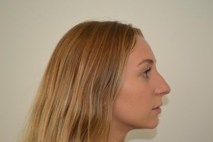 Rhinoplasty Before & After Patient #19713