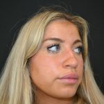 Rhinoplasty Before & After Patient #19763