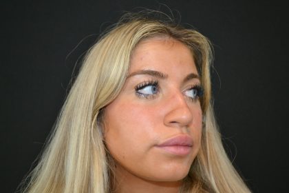 Rhinoplasty Before & After Patient #19763