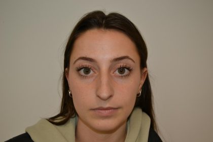 Rhinoplasty Before & After Patient #19711