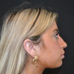 Rhinoplasty Before & After Patient #19763