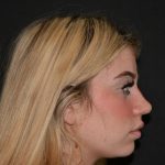 Rhinoplasty Before & After Patient #19763
