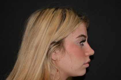 Rhinoplasty Before & After Patient #19763