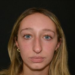 Rhinoplasty Before & After Patient #19764
