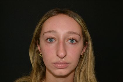 Rhinoplasty Before & After Patient #19764