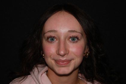 Rhinoplasty Before & After Patient #19764
