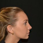 Rhinoplasty Before & After Patient #19713