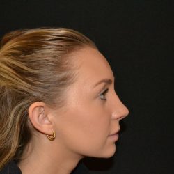 Rhinoplasty Before & After Patient #19713