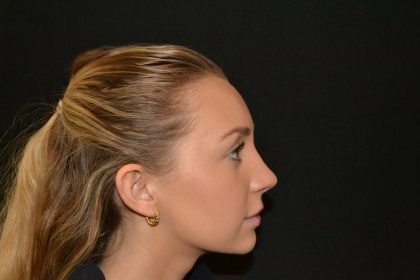 Rhinoplasty Before & After Patient #19713