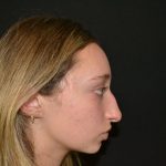 Rhinoplasty Before & After Patient #19764