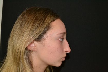 Rhinoplasty Before & After Patient #19764