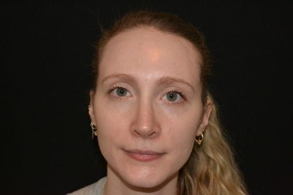 Rhinoplasty Before & After Patient #19714