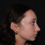 Rhinoplasty Before & After Patient #19764