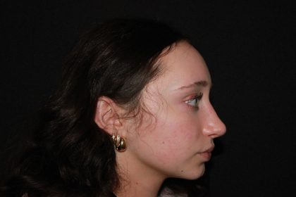 Rhinoplasty Before & After Patient #19764